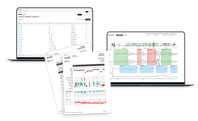 Exempel på ApneaLink Air-rapporter i AirView, på två datorskärmar och som utskrifter.