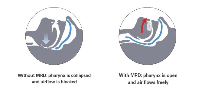 oral-appliance-upper-airway-mechanism-resmed