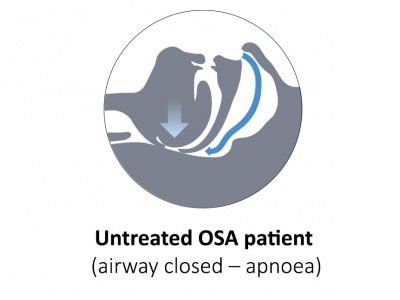  sdb-untreatedosapatient