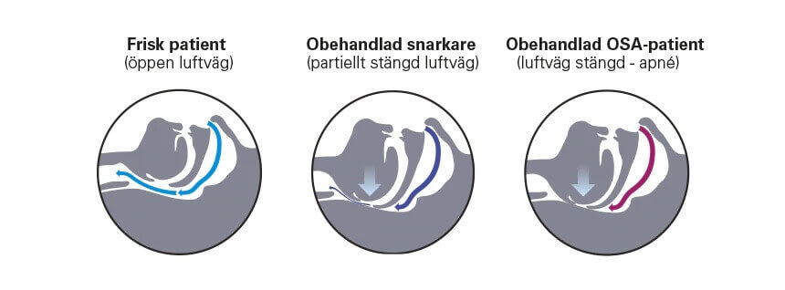 vad som orsakar snarkning diagram luftflöde hals